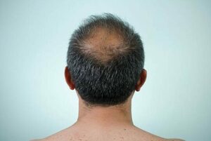 الصلع عند الرجال أسبابه و علاجه