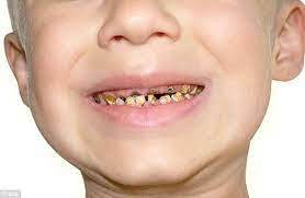 علاج تسوس الاسنان عند الاطفال 3 سنوات