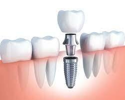 أهم التوصيات حول زراعة الأسنان