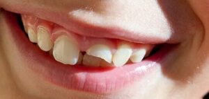 تكسر الأسنان ماذا تفعل إذا كسر السن؟