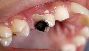 تسوس اسنان الاطفال وعلاجه طبيعيا | بيت الصحة