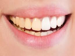 لون الأسنان الصحية.. بيضاء أم صفراء؟ | مصراوى