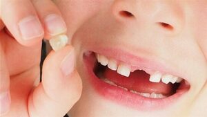 اسباب ظهور الاسنان الدائمة قبل سقوط اللبنية | المرسال