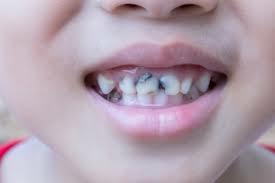 ما هو علاج تسوس اسنان الاطفال ؟ | عيادة كوروش للاسنان | ابتسامة هوليود | زراعة الاسنان