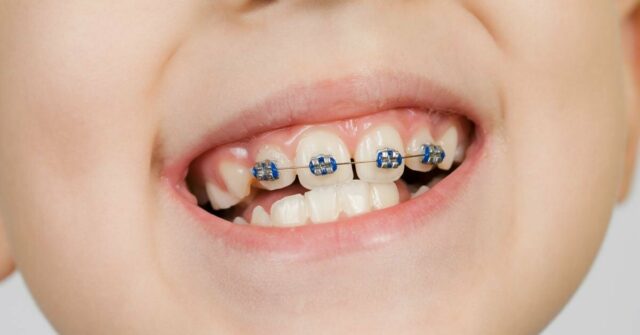 تقويم الأسنان للأطفال
