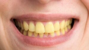 ما سبب اصفرار الأسنان وكيفية علاجها - شبكة الأبحاث العربية