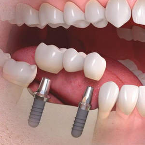 زراعة الاسنان – مركز عناية الطبى