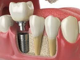 ما هي زراعة الأسنان الفورية؟ - فيديو
