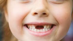 الأسنان اللبنية.. أهميتها ومشكلاتها الشائعة