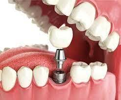 أهم التوصيات حول زراعة الأسنان