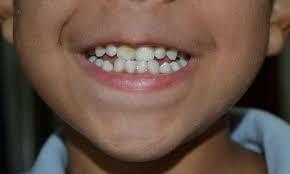 أسباب ظهور بقع بنية على أسنان الأطفال