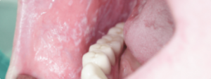 التهاب الفم، الأعراض والعلاج